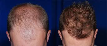 Difference between Organic and Medical Hair Restoration